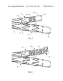 Socket For Fenestrated Tubular Prosthesis diagram and image