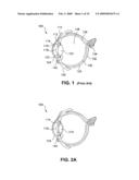 MULTI-FOCAL INTRAOCULAR LENS SYSTEM AND METHODS diagram and image