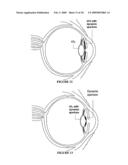 OPHTHALMIC DYNAMIC APERTURE diagram and image