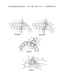 Cure through laminate veneer applicator diagram and image