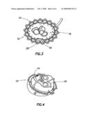 Device for Proactive Modulation of Cardiac Strain Patterns diagram and image