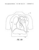 USING ACOUSTIC ENERGY TO COMPUTE A LUNG EDEMA FLUID STATUS INDICATION diagram and image