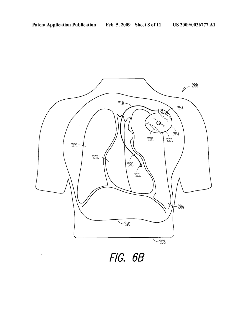 USING ACOUSTIC ENERGY TO COMPUTE A LUNG EDEMA FLUID STATUS INDICATION - diagram, schematic, and image 09