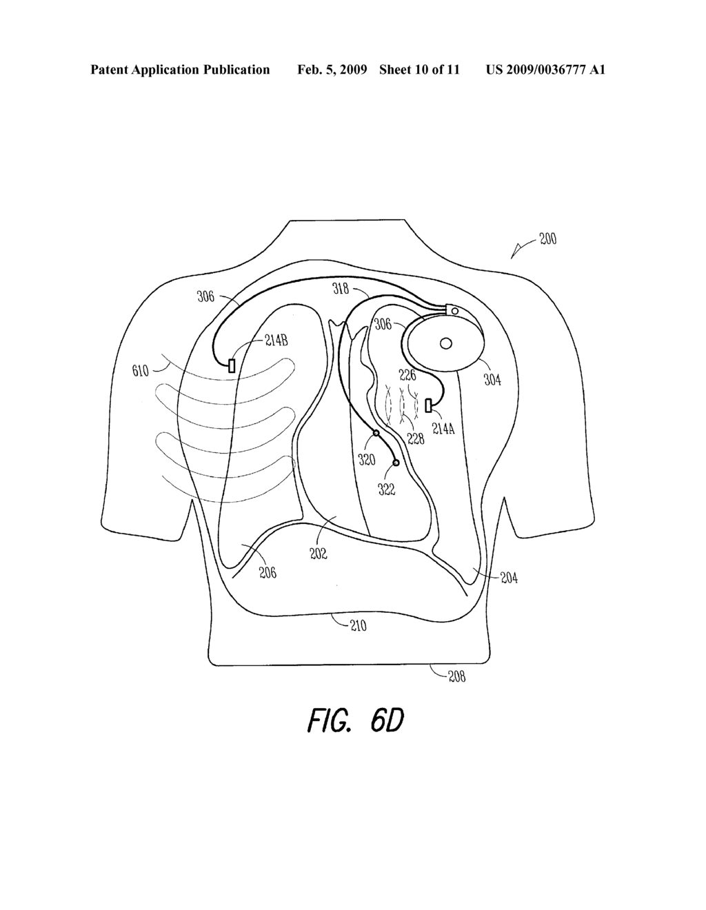 USING ACOUSTIC ENERGY TO COMPUTE A LUNG EDEMA FLUID STATUS INDICATION - diagram, schematic, and image 11