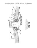 Anastomosis Instrument and Method for Performing Same diagram and image