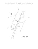 Systems and methods for accommodating anatomical characteristics in the treatment of septal defects diagram and image