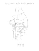 Systems and methods for accommodating anatomical characteristics in the treatment of septal defects diagram and image