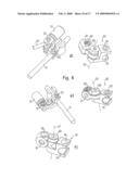 INTERVERTEBRAL STABILIZATION SYSTEM diagram and image