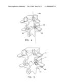 Method and apparatus for spinal facet fusion diagram and image