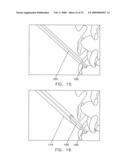 Method and apparatus for spinal facet fusion diagram and image