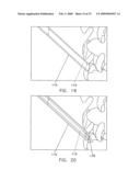 Method and apparatus for spinal facet fusion diagram and image