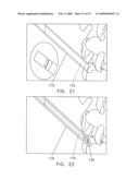 Method and apparatus for spinal facet fusion diagram and image