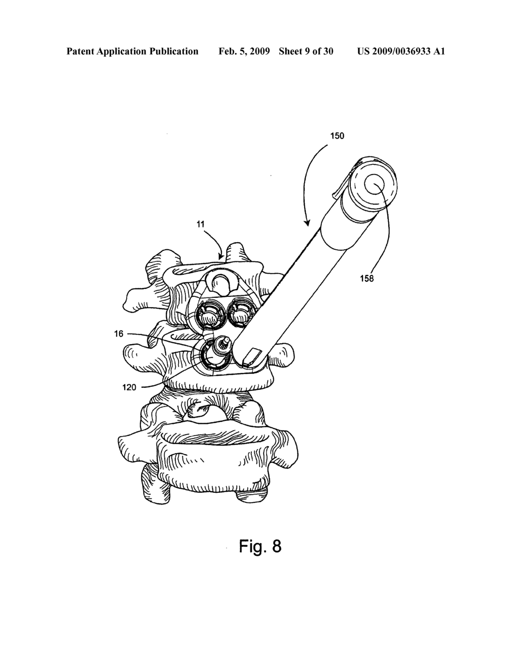 System and method for vertebral body plating - diagram, schematic, and image 10