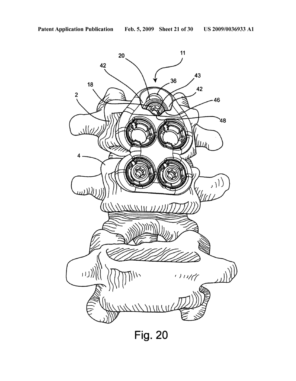System and method for vertebral body plating - diagram, schematic, and image 22