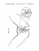 PELVIC DISORDER TREATMENTS diagram and image