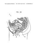 PELVIC DISORDER TREATMENTS diagram and image