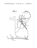 Transvenous Phrenic Nerve Stimulation System diagram and image