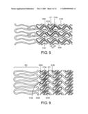 Expandable Prostheses for Treating Atherosclerotic Lesions Including Vulnerable Plaques diagram and image