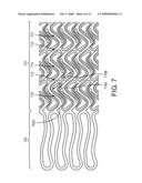 Expandable Prostheses for Treating Atherosclerotic Lesions Including Vulnerable Plaques diagram and image