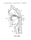 INDUCTIVE POWER TRANSFER SYSTEM FOR PALATAL IMPLANT diagram and image