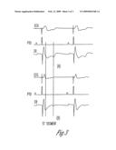 INTERMITTENT STRESS AUGMENTATION PACING FOR CARDIOPROTECTIVE EFFECT diagram and image