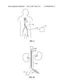 Devices and methods for using endovascular cooling to treat septic shock and other disorders diagram and image