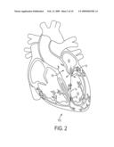 Mitral Spacer diagram and image