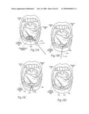 Implantable devices, systems, and methods for maintaining desired orientations in targeted tissue regions diagram and image