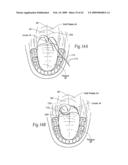 Implantable devices, systems, and methods for maintaining desired orientations in targeted tissue regions diagram and image