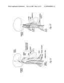 BAROREFLEX STIMULATION TO TREAT ACUTE MYOCARDIAL INFARCTION diagram and image