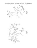 BAROREFLEX STIMULATION TO TREAT ACUTE MYOCARDIAL INFARCTION diagram and image