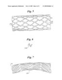  Stent Configurations diagram and image