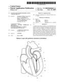 System and Method for Implanting a Heart Implant diagram and image