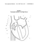 System and Method for Implanting a Heart Implant diagram and image