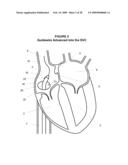 System and Method for Implanting a Heart Implant diagram and image