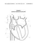 System and Method for Implanting a Heart Implant diagram and image