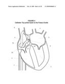 System and Method for Implanting a Heart Implant diagram and image