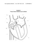 System and Method for Implanting a Heart Implant diagram and image