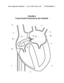 System and Method for Implanting a Heart Implant diagram and image