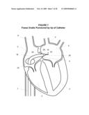 System and Method for Implanting a Heart Implant diagram and image