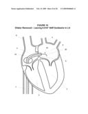 System and Method for Implanting a Heart Implant diagram and image