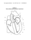 System and Method for Implanting a Heart Implant diagram and image