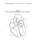 System and Method for Implanting a Heart Implant diagram and image