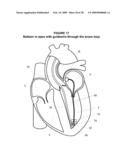 System and Method for Implanting a Heart Implant diagram and image