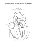 System and Method for Implanting a Heart Implant diagram and image