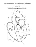 System and Method for Implanting a Heart Implant diagram and image