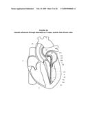 System and Method for Implanting a Heart Implant diagram and image