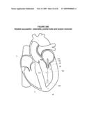 System and Method for Implanting a Heart Implant diagram and image