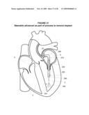 System and Method for Implanting a Heart Implant diagram and image