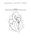 System and Method for Implanting a Heart Implant diagram and image